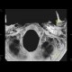 Fissure of occipital bone, terminating in foramen magnum: CT - Computed tomography